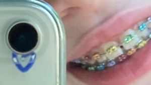 My fvcking Rainbow braces