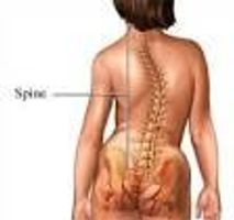 Living With Scoliosis