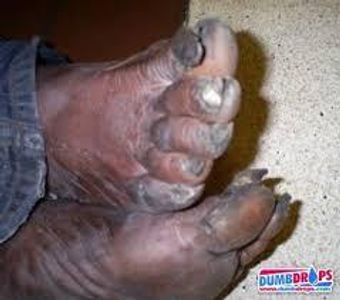 crusty toes