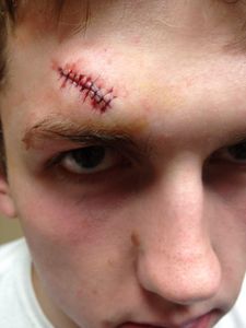 Which of the following basketball injuries affects the head?