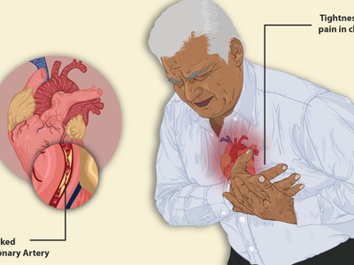 What is a common symptom of angina?