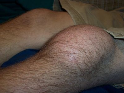 What is the term used for an injury in which the patella (kneecap) slides out of its normal position?