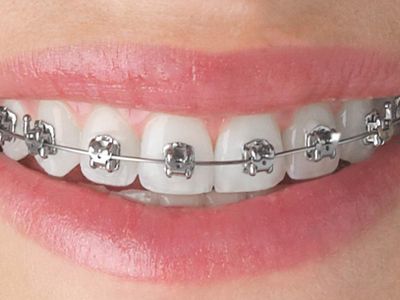 Have I ever had braces?