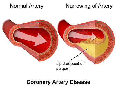 Which of the following can help in reducing the risk of heart disease?