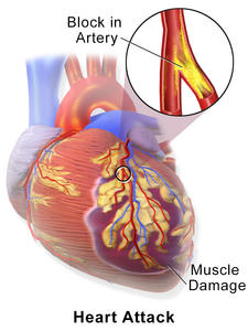 Which of the following is a symptom of a heart attack?