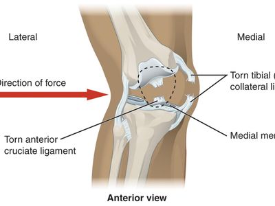 What injury occurs when a ligament in the thumb is stretched or torn?