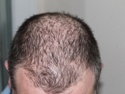 Who is known for his hair transplant procedure?