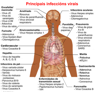 Which of the following is a viral disease?