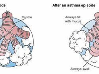 Which condition is characterized by inflammation of the bronchial tubes?