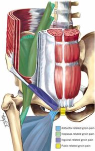 Which of the following is used to protect the groin area during games?