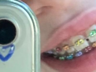 My fvcking Rainbow braces