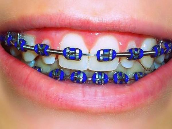 Do you where braces?