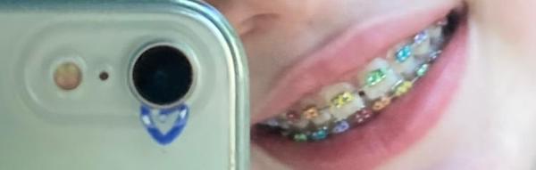 My fvcking Rainbow braces