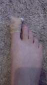 I  injured my toe DX