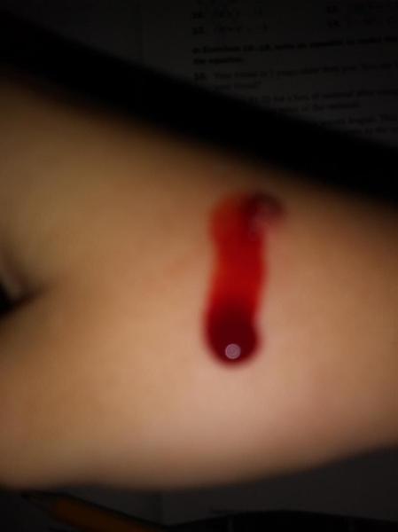 I picked my scab and it bleededed alot.